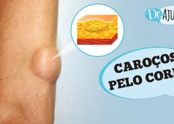 Caroços pelo corpo e lipoma: O que são? O que reparar?